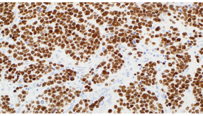 Pediatric-Pathology PHOX2B (EP312)
