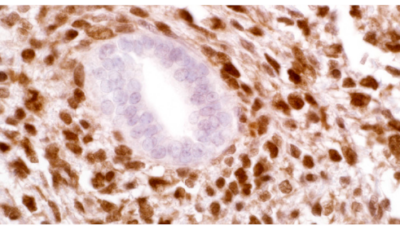 Pediatric-Pathology2 CITED1 (5H6)