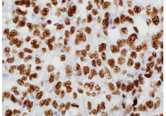 Pediatric-Pathology5 TFE3 (MRQ-37)