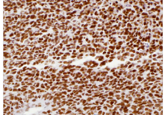 Pediatric-Pathology6 INI-1 (MRQ-27)