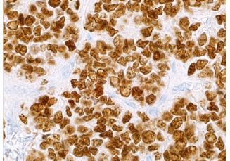 Pediatric-Pathology3 NKX2.2 (EP336)