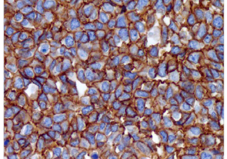 Pediatric-Pathology4 CD99 (EPR3097Y)